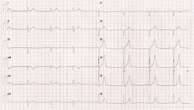 Rycina 2. Badanie elektrokardiograficzne, przesuw 25 mm/s, amplituda 10 mV. Zapis typowy dla osoby uprawiającej sport. Bradykardia zatokowa 44/min, oś serca pośrednia (-28°), blok przedsionkowo-komorowy I stopnia, cechy przerostu lewej komory, wysokie odejście punktu J w odprowadzeniach V3 i V4