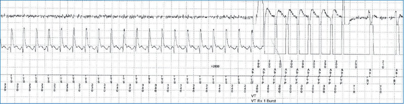 Rycina 1. Zapis elektrograficzny (EGM) u chorego z ICD i częstoskurczem komorowym prawidłowo zdetekowanym przez urządzenie. Prawidłowo rozpoznany przez urządzenie częstoskurcz komorowy zostaje przerwany przez terapię antytachyarytmiczną (Burst)