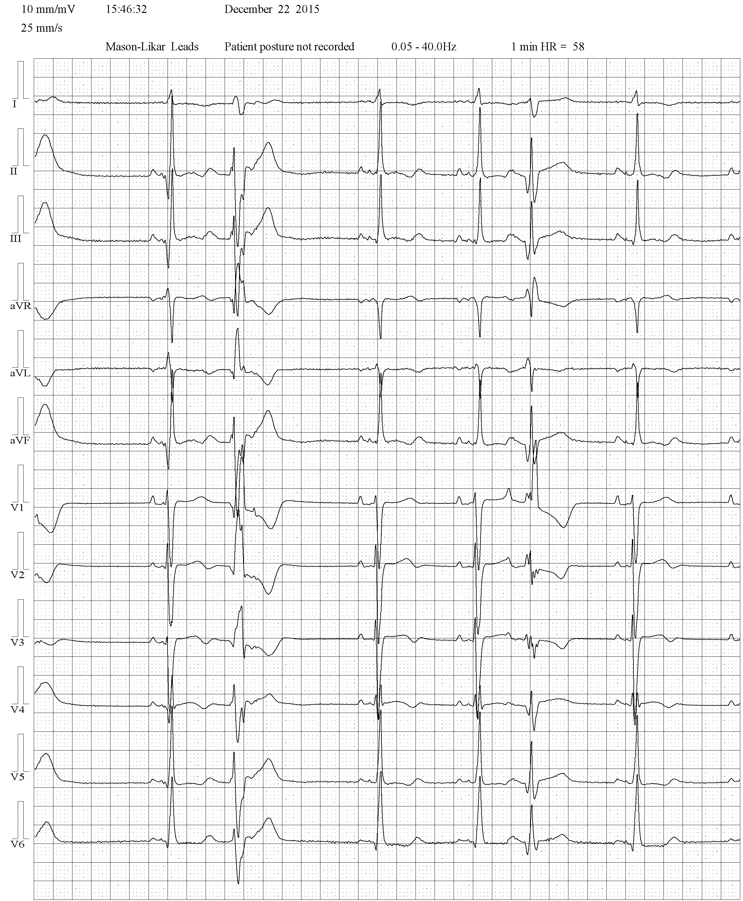 Rycina 4. Pierwsze pobudzenie przedwczesne jest pochodzenia komorowego – widoczny jest wsteczny załamek P z RP >100 ms, jest ujemny w II, III, aVF. Pobudzenie ma obraz RBBB z qR w V1, r <S w V6, czas trwania około 180 ms. Drugie pobudzenie, również o morfologii RBBB, jest pobudzeniem przedsionkowym z widocznym P’ (zwłaszcza w V1 i V2), morfologią rR’ w V1 (a właściwie typu R z głębokim zazębieniem na ramieniu wstępującym zespołu) oraz R >S w V6, czas trwania 150-160 ms 