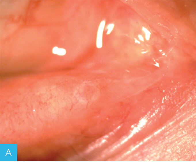 Rycina 1A-C. Leczenie zwężenia punktu łzowego za pomocą implantów perforowanych. A. Stenoza dolnego punktu łzowego. B. Implant perforated plug (firmy FCI) wszczepiony do punktu łzowego. C. Punkt łzowy po usunięciu implantu