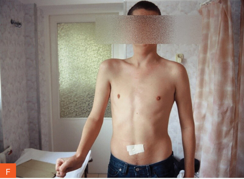 Rycina 5A-F. Jednostronne zaniki mięśniowe. A-D. Stan po miesiącu od ostrej fazy choroby. E, F. Stan po roku i wielomiesięcznej rehabilitacji porażenia czterokończynowego