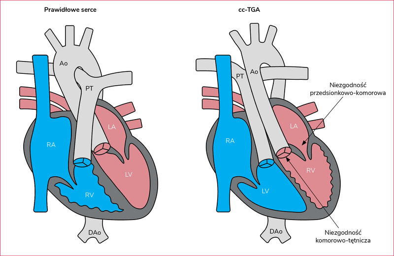 Rycina 1. Skorygowane przełożenie wielkich naczyń (cc-TGA) – anatomia (schemat)