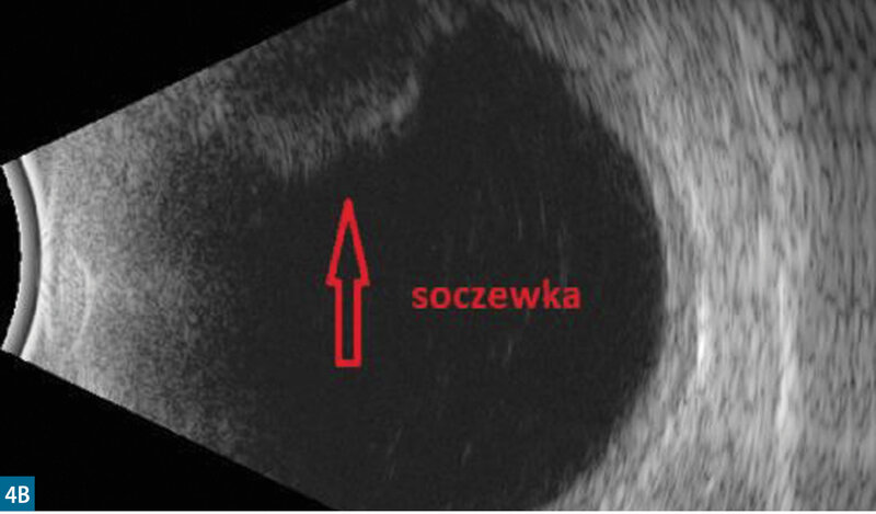 Rycina 4. Pacjentka ze skrajnie zaawansowaną, dokonaną jaskrą fakomorficzną. W UBM widoczny kontakt tęczówkowo-rogówkowy z przyleganiem całej powierzchni tęczówki do śródbłonka na obszarze 360° i pęczniejącą soczewką, która wraz z przypartą tęczówką wypełnia całą komorę przednią (A). Badanie USG w prezentacji B potwierdza występowanie bardzo dużej soczewki u pacjentki