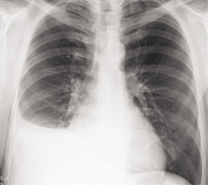 Rycina 6. Badanie radiologiczne klatki piersiowej: płyn w prawej jamie opłucnowej