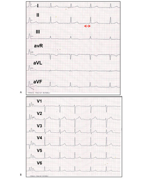 Rycina 2 A i B. Chłopiec w wieku 14 lat, piłkarz. EKG – normogram, rytm zatokowy 75/min, czas PQ 240 ms → blok przedsionkowo-komorowy I stopnia, czas QRS 0,1 s, czas QTc 0,41 s. Bez przerostów.