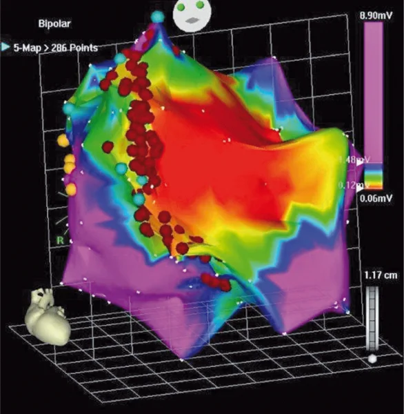 Rycina 3. Dwubiegunowa endokawitarna mapa napięciowa lewej komory uzyskana systemem elektroanatomicznym CARTO w trakcie rytmu zatokowego u chorego po zawale mięśnia sercowego ściany przedniej, z LVEF 25%, wszczepionym ICD z powodu VT, z burzą elektryczną.