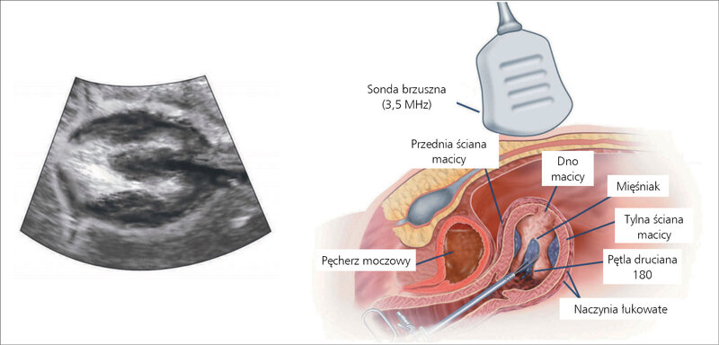 Rycina 2. Technika myoma coring.