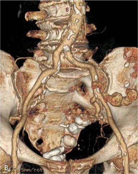 Rycina 1. Angio-TK aorty [A], tętnic biodrowych i udowych [B] oraz angiogram lewej tętnicy podobojczykowej [C]. Czarną strzałką oznaczono ok. 50% zwężenie w tętnicy podobojczykowej lewej.
