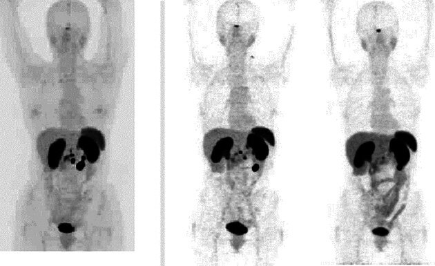 Ryc. 5. Badania PET-CT po podaniu 68Ga-DOTA-TATE. Wynik leczenia radioizotopowego rozsianego procesu nowotworowego (guz neuroendokrynny).
