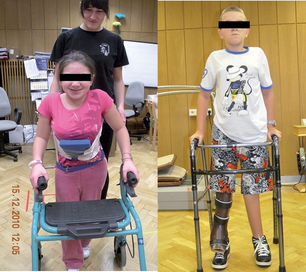Rycina 7. Dzieci z IV typem OI podczas nauki chodzenia.