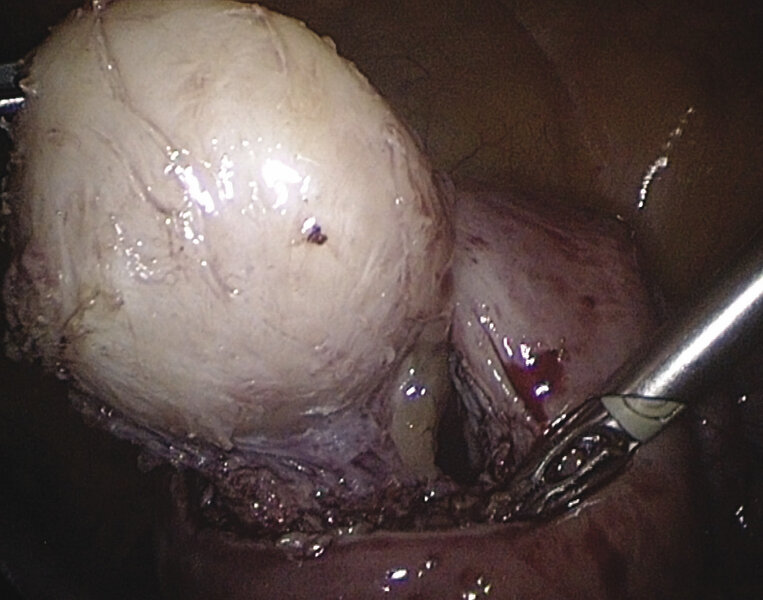 Rycina 6. Widoczna otwarta jama macicy z fragmentem endometrium