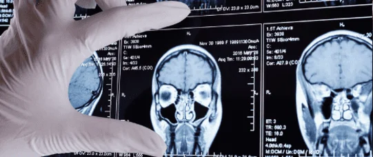 Trombektomia – obietnice bez pokrycia?