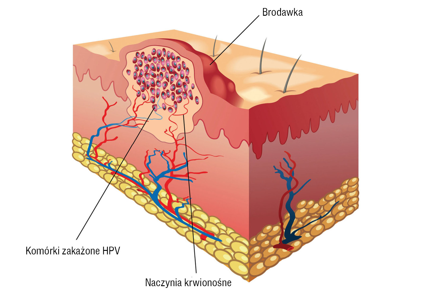 Zakażenia HPV