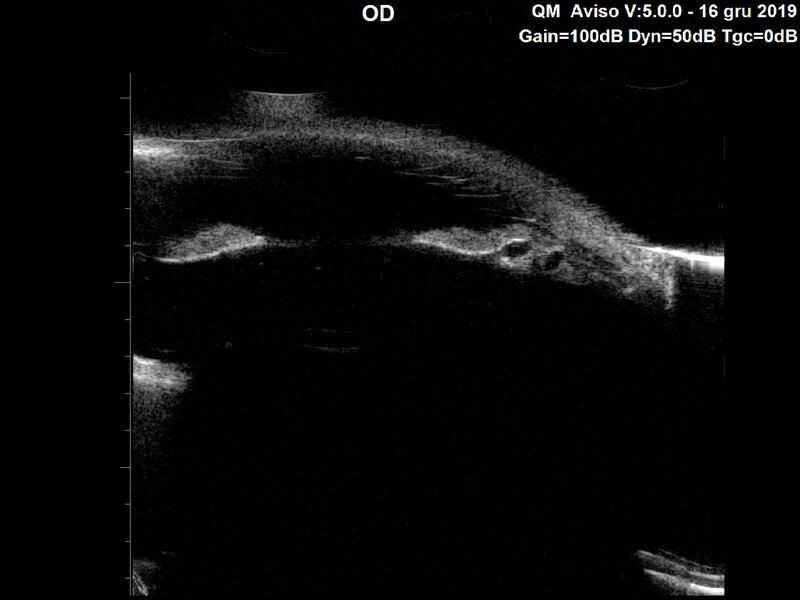 Rycina 1. Skan ultrabiomikroskopii (UBM) pacjentki, na którym uwidoczniono dwie torbiele o wymiarach ok. 0,7 × 1,3 mm. Jedna z nich wychodzi prawdopodobnie z nabłonka barwnikowego ciała rzęskowego, a druga z nabłonka barwnikowego tęczówki