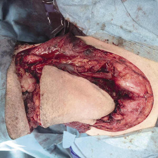 Ryc. 7. Przeniesiony alloprzeszczep w ubytek biorcy.
