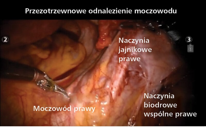 Film wideo 1. Pięć etapów histerektomii z użyciem robota
