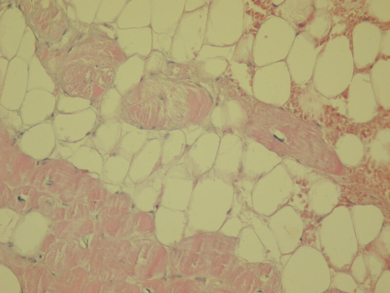 Rycina 12. Biopsja endomiokardialna. Arytmogenna kardiomiopatia prawej komory. Pomiędzy komórkami mięśniowymi obecna tkanka tłuszczowa. Barwienie histochemiczne (hematoksylina i eozyna)