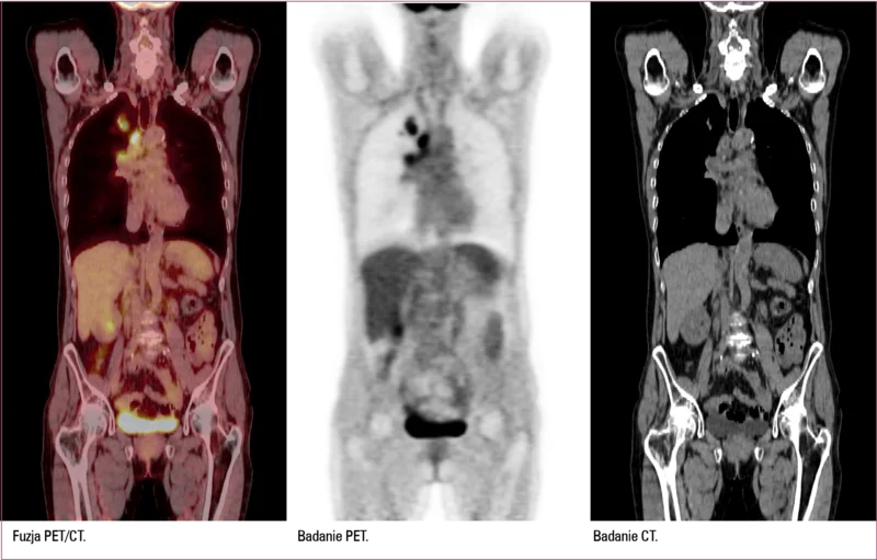 
 
 
 
 Badanie PET/CT po podaniu 18FDG u pacjenta z guzem płuca i przerzutami do węzłów chłonnych.