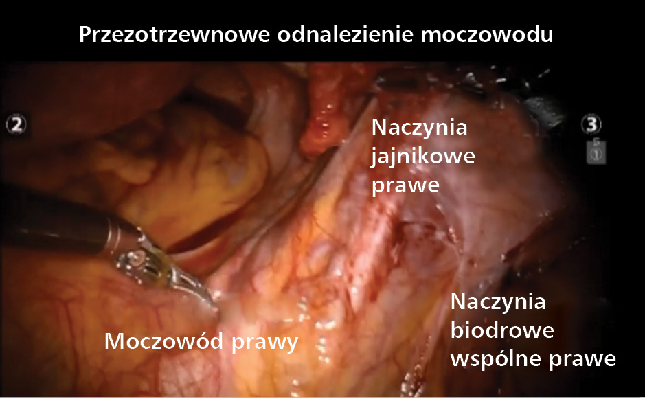 Film wideo 1. Pięć etapów histerektomii z użyciem robota