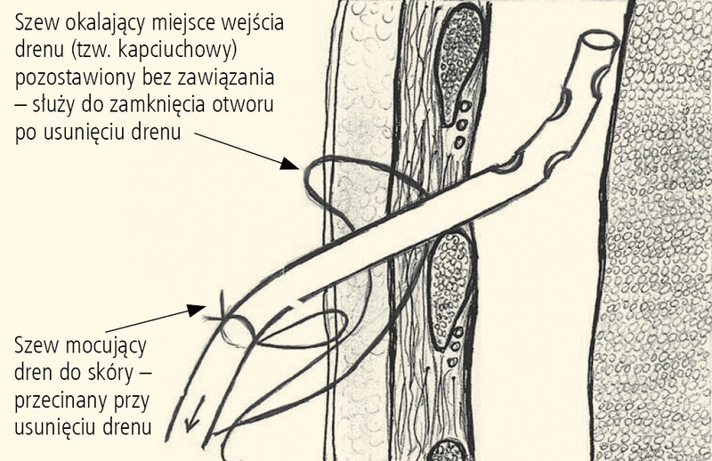 Rycina 6. Prawidłowo założony drenaż jamy opłucnej.