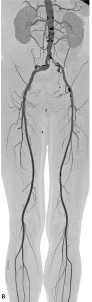 RYCINA 1. Angiografia TK (rekonstrukcje VR [A] i MIP [B]) tętnic obwodowych, angiografia TK (rekonstrukcja VR) serca i tętnic wieńcowych [C] oraz angiografia TK aorty (warstwa poprzeczna na poziomie tętniaka aorty brzusznej) [D] u pacjenta z podejrzeniem choroby wieńcowej. Badanie uwidoczniło prawidłowy obraz tętnic wieńcowych, rozwarstwienie w tętniaku aorty brzusznej, obecność podwójnych tętnic nerkowych, krytyczne zwężenie lewej tętnicy biodrowej wspólnej (Kardiol Dypl 2006; 5 (4): 97-100).