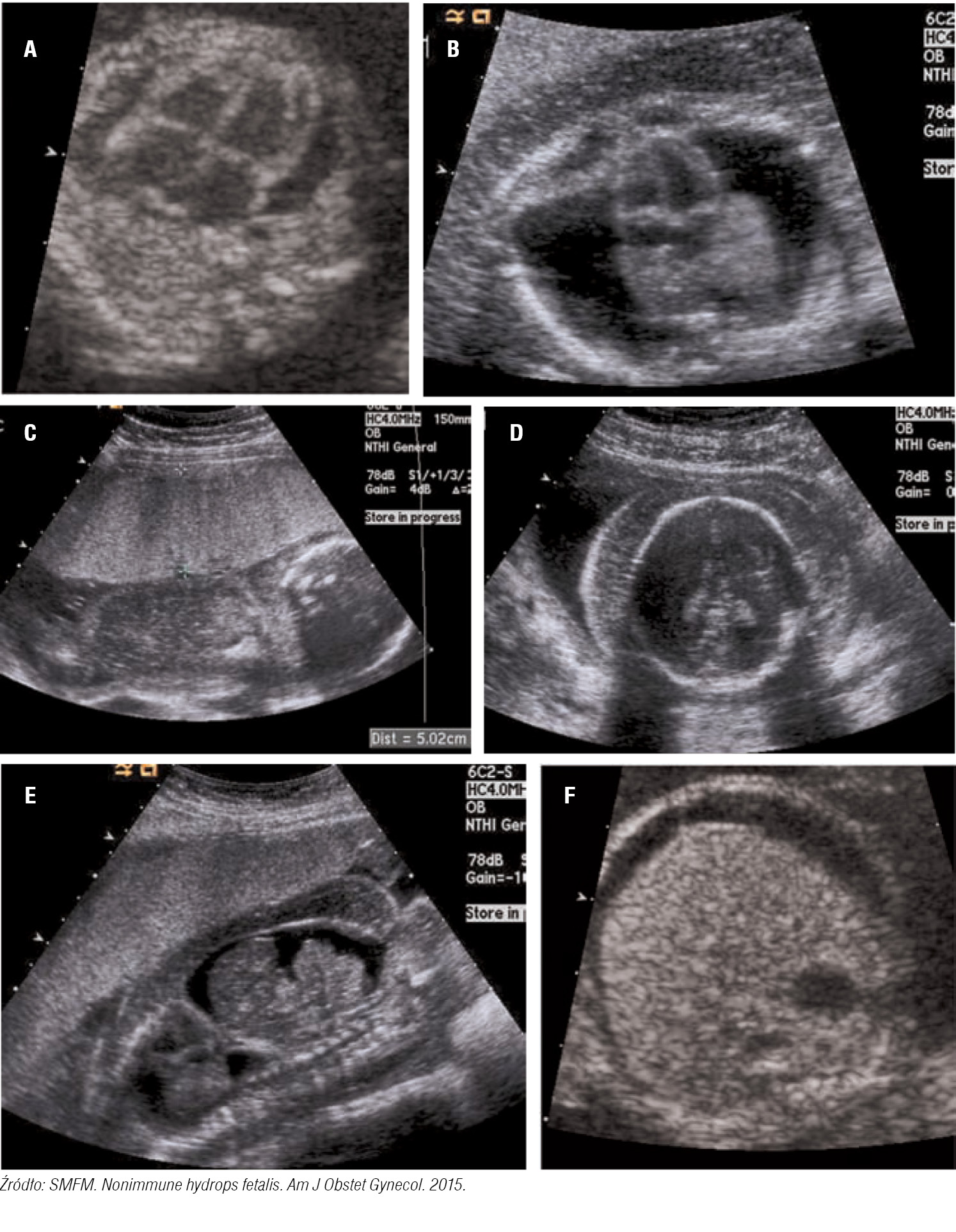 Rycina 1. Objawy stwierdzane w&nbsp;badaniu USG w&nbsp;przypadku nieimmunologicznego obrzęku płodu