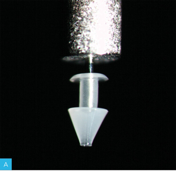 Rycina 2A i B. Okluzyjne implanty trwałe punktów łzowych. A. Implant silikonowy Micro Flow Pre-Loaded Punctal Ocluder (firmy BVI). B. Zatyczka hydrożelowa FORM FIT® (Oasis Medical, Glendora) w trakcie uwadniania i formowania w punkcie łzowym