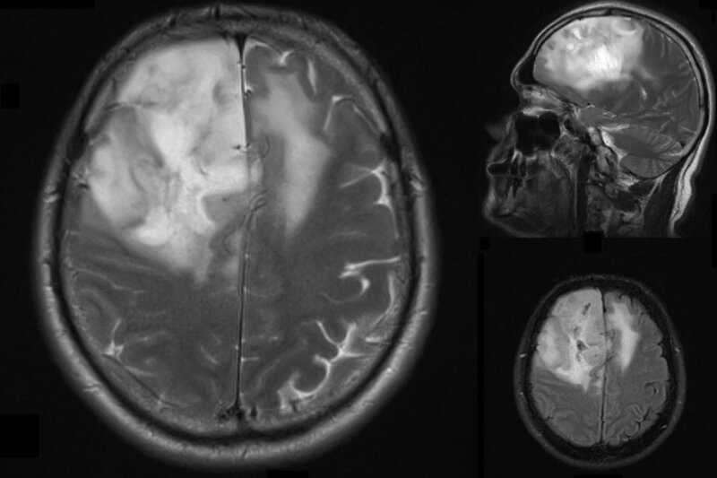 Ryc. 1. Glejak WHO II w badaniu MRI.