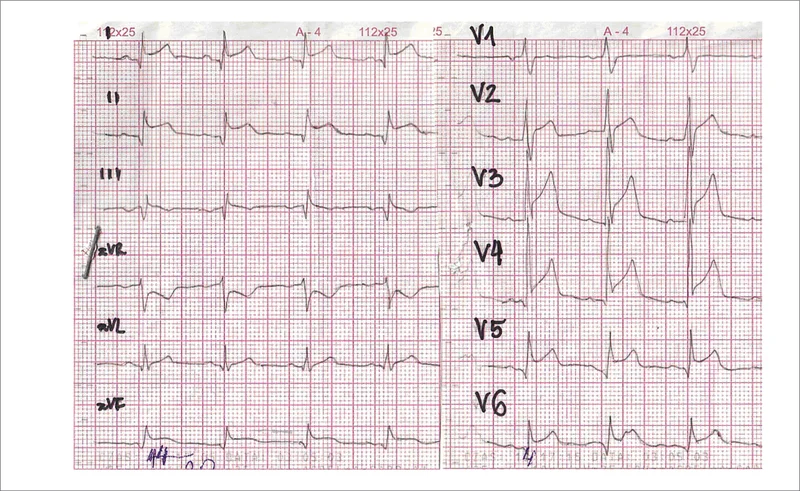Rycina 2. EKG 58-letniego mężczyzny z wywiadem 3-godzinnego bólu zamostkowego. W koronarografii stwierdzono zamknięcie GPZ w odcinku środkowym.