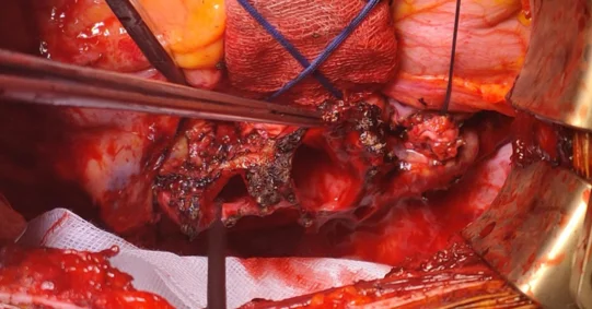Zabrzańscy kardiochirurdzy wykonali drugą taką na świecie transplantację obu płuc 