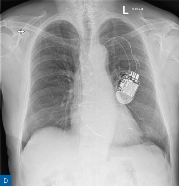 Rycina 1. Obraz radiologiczny w procesie identyfikacji kardiologicznego urządzenia wszczepialnego (CIED). A. Rozrusznik dwujamowy. B. Kardiowerter-defibrylator dwujamowy. C. Kardiowerter-defibrylator podskórny. D. Urządzenie do terapii resynchronizującej z funkcją defibrylacji E. Pętlowy rejestrator zdarzeń oraz rozrusznik dwujamowy. F. Stymulator bezelektrodowy typu Micra. G. Stymulator bezelektrodowy Abbott AVEIR. H. Układ poprawiający kurczliwość mięśnia sercowego (strona prawa) oraz kardiowerter-defibrylator jednojamowy (strona lewa)
