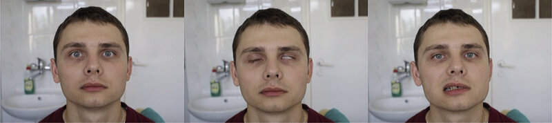Rycina 4. Obustronne niejednoczesne porażenie nerwu VII. Chory nie marszczy czoła, nie zamyka powiek (asymetria szpar powiekowych), nie szczerzy zębów (asymetria kącika ust P<L).