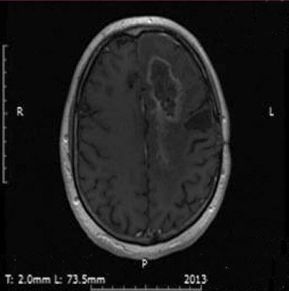 4. Badanie MRI 58 tygodni po rozpoczęciu leczenia.