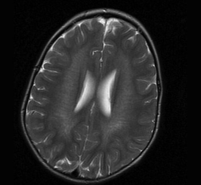 Rycina 4. Leukodystrofia metachromatyczna (MLD) potwierdzona molekularnie. MR,  sekwencja T2. W istocie białej głębokiej widoczne jeszcze zachowane włókna nerwowe u 3-letniego chłopca z 3-miesięcznym wywiadem chorobowym i objawami ataksji móżdżkowej