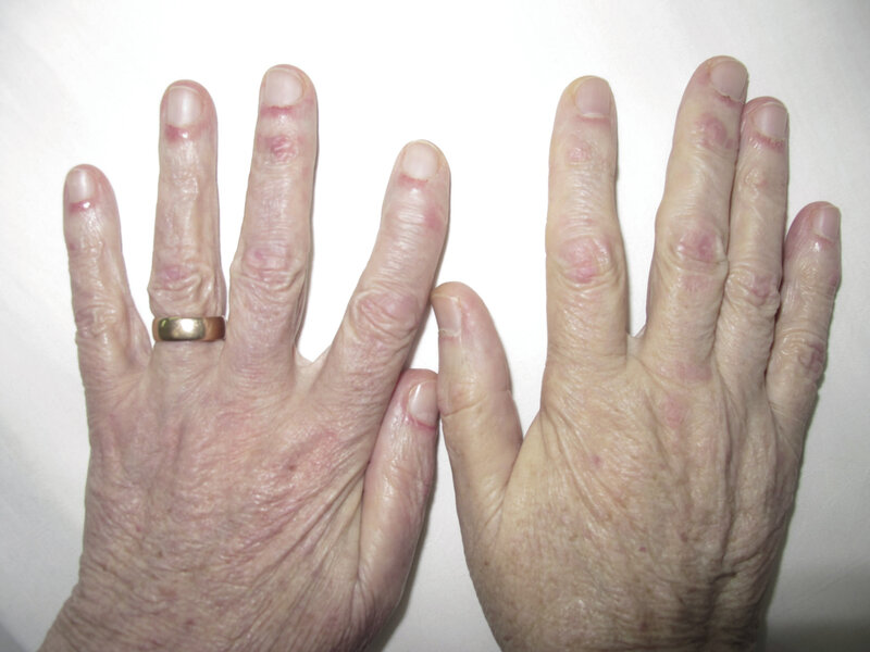 Ryc. 13-14. Dermatomyositis.