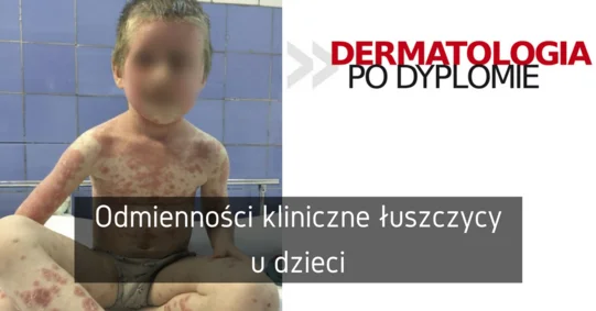 Odmienności kliniczne łuszczycy u dzieci