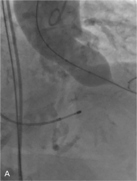 Rycina 3. Kolejne etapy implantacji zastawki CoreValve™.