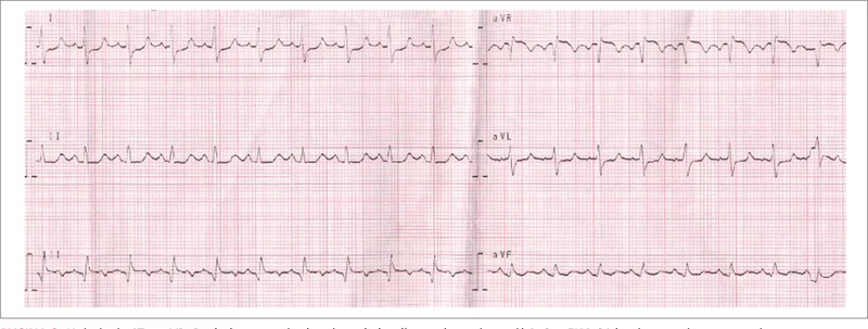 Rycina 3. Uniesienie ST w aVR. Dodatkowo stwierdza się tachykardię zatokową i zespół SI-QIII. EKG 64-letniego mężczyzny przyjętego z bólem w klatce piersiowej, silną dusznością oraz podwyższonym stężeniem troponiny we wstrząsie kardiogennym. We wstępnie wykonanej koronarografii wykryto nieistotne zmiany miażdżycowe, a w badaniu echokardiograficznym ostre przeciążenie prawej komory. Angio-TK tętnic płucnych potwierdziło ostrą zatorowość płucną.