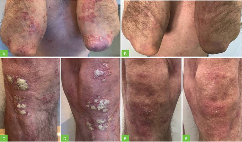 Rycina 2A-F. Pacjent 2. Zmiany skórne na łokciach przed leczeniem (A) i po terapii (B) oraz na kolanach przed leczeniem (C, D) i po terapii (E, F)