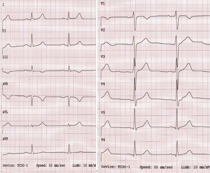 Rycina 10. EKG dziecka 14-letniego.