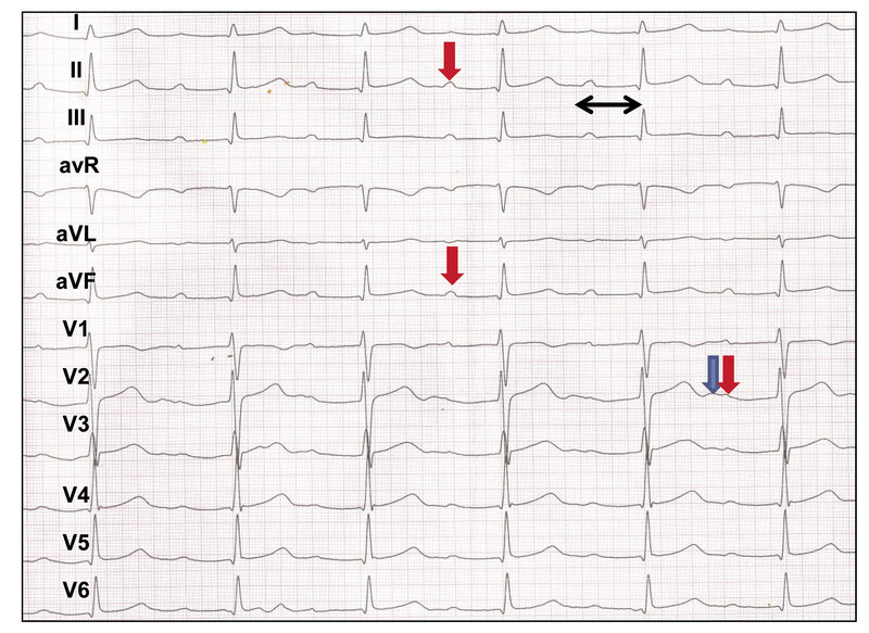 Rycina 9. Dziewczynka w wieku 12 lat, pływaczka, klasa sportowa. Zapis EKG (równoczesna rejestracja z 12 odprowadzeń) – normogram, rytm zatokowy  68/min, z utrwalonym blokiem przedsionkowo-komorowym I stopnia i czasem PQ 0,36 s, QRS 0,08 s, QT 0,4 s (w niektórych odprowadzeniach przedsercowych za załamkiem T widoczna fala U [strzałka niebieska], ale ponieważ jej amplituda nie przekracza 50% amplitudy załamka T, nie jest wliczana do obliczania czasu QTc). W odprowadzeniu V2-V3 widać zachodzenie zatokowego załamka P (czerwona strzałka) na falę U (niebieska strzałka).