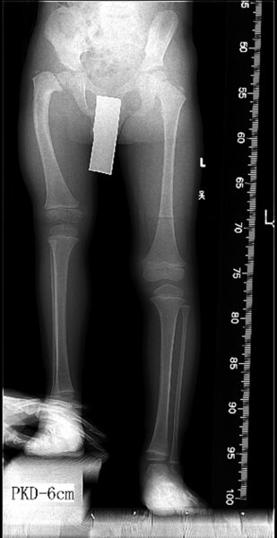 Ryc. 2. Radiogram przedoperacyjny czteroletniego chłopca z wrodzonym niedorozwojem prawego uda (deformacja biodra, skrócenie prawej kończyny dolnej 6 cm).