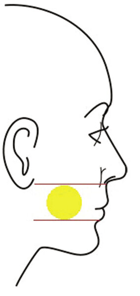 Ryc. 1. Orientacyjne linie pomocnicze – według nich możliwe jest zwizualizowanie obszaru anatomicznego, w zakresie którego usunięcie odpowiedniej objętości fragmentu ciała tłuszczowego zapewnia właściwe modelowanie policzków oraz zaakcentowanie kości jarzmowych i dolnego brzegu żuchwy (na podstawie Niamtu J, III, Comsetic Facial Surgery, Second Ed., Elsevier, 2016). 
