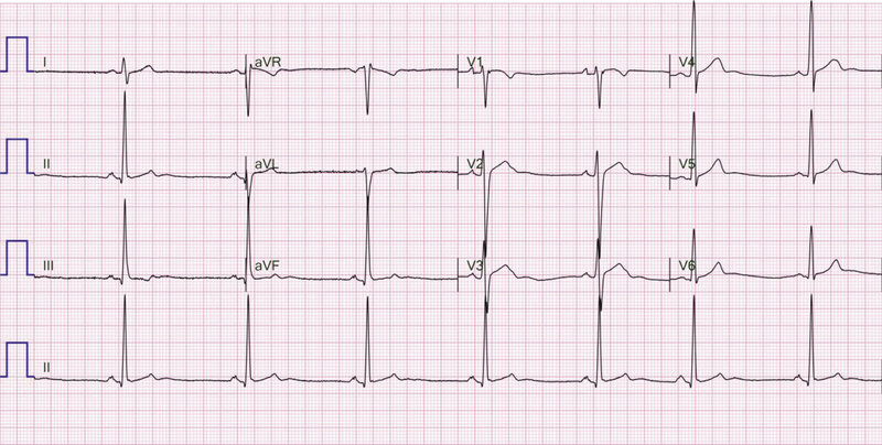 Rycina 1. Zapis 12-kanałowego EKG 36-letniego sportowca ze zdiagnozowaną arytmogenną kardiomiopatią prawokomorową,  u którego w rezonansie magnetycznym serca stwierdzono regionalne zaburzenia kurczliwości prawej komory. W zapisie widoczne TAD (terminal activation delay) 63 ms w odprowadzeniach V1 i V2