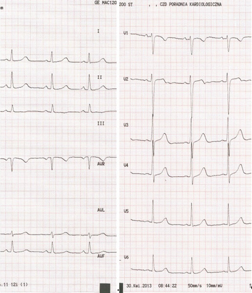 Rycina 7. EKG dziecka 5-letniego.