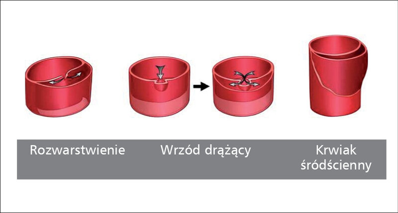 Rycina 1. Podział ostrych zespołów aortalnych.Nienaber C. A Eur Heart J 2012;33:26-35. Przedrukowano za zgodą.