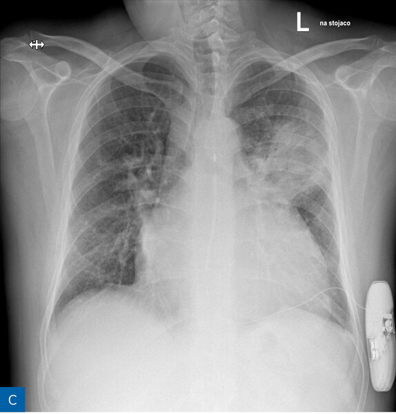 Rycina 1. Obraz radiologiczny w procesie identyfikacji kardiologicznego urządzenia wszczepialnego (CIED). A. Rozrusznik dwujamowy. B. Kardiowerter-defibrylator dwujamowy. C. Kardiowerter-defibrylator podskórny. D. Urządzenie do terapii resynchronizującej z funkcją defibrylacji E. Pętlowy rejestrator zdarzeń oraz rozrusznik dwujamowy. F. Stymulator bezelektrodowy typu Micra. G. Stymulator bezelektrodowy Abbott AVEIR. H. Układ poprawiający kurczliwość mięśnia sercowego (strona prawa) oraz kardiowerter-defibrylator jednojamowy (strona lewa)