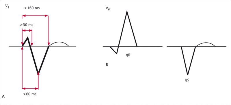 RYCINA 2. Morfologia zespołów QRS zbliżona do LBBB – cechy częstoskurczu komorowego.