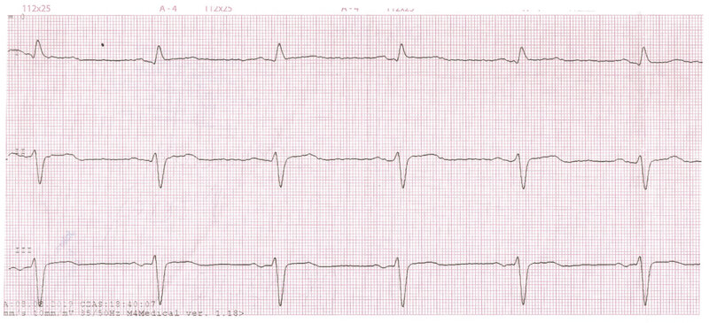 Rycina 1. Elektrokardiogram pacjenta z zawałem mięśnia sercowego z uniesieniem odcinka ST (STEMI) ściany przedniej. Przesuw 50 mm/s. Rytm zatokowy, 63/min, lewogram, blok przedniej wiązki lewej odnogi pęczka Hisa, cechy martwicy w obrębie ściany przedniej, ostry zespół wieńcowy z uniesieniem odcinka ST ściany przedniej (2 doba zawału). W odprowadzeniach V4-V5 pojawiają się ujemne załamki T