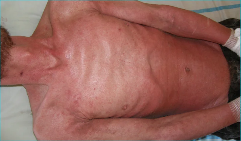  Rycina 1. Erytrodermia u pacjenta z pełnoobjawowym AIDS